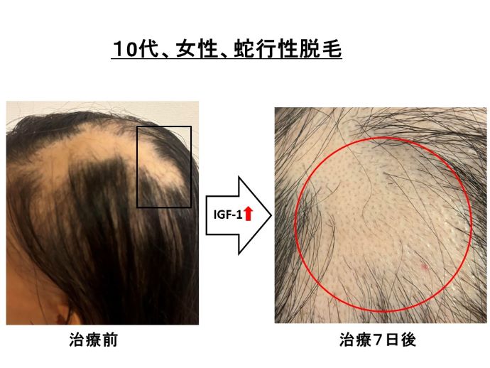 円形脱毛症　病院